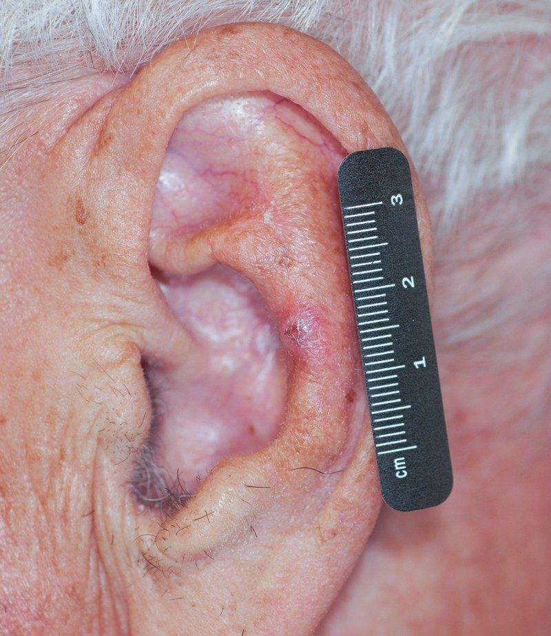 Skin Cancer
