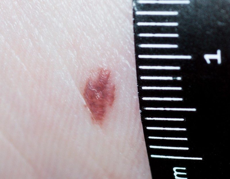 A pigmented basal cell carcinoma with shiny areas, speckled pigment and asymmetrical shape.