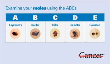Moles Skin Cancer