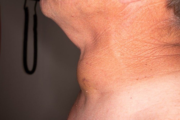 thyroid cancer symptoms pictures
