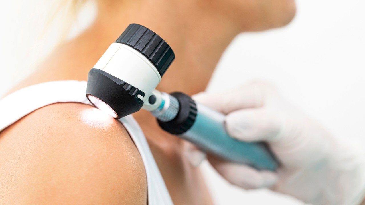 When Is It Important to Get Mole Removal?   Westover Hills Dermatology