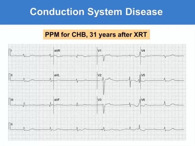 Chart showing conduction system disease