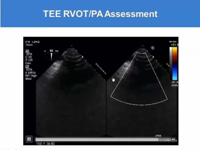 TEE RVOT/PA Assessment