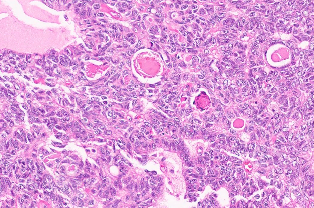 Gyn Mesonephric-Like Adenocarcinoma