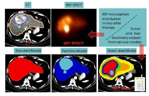 90Y Microsphere Therapy