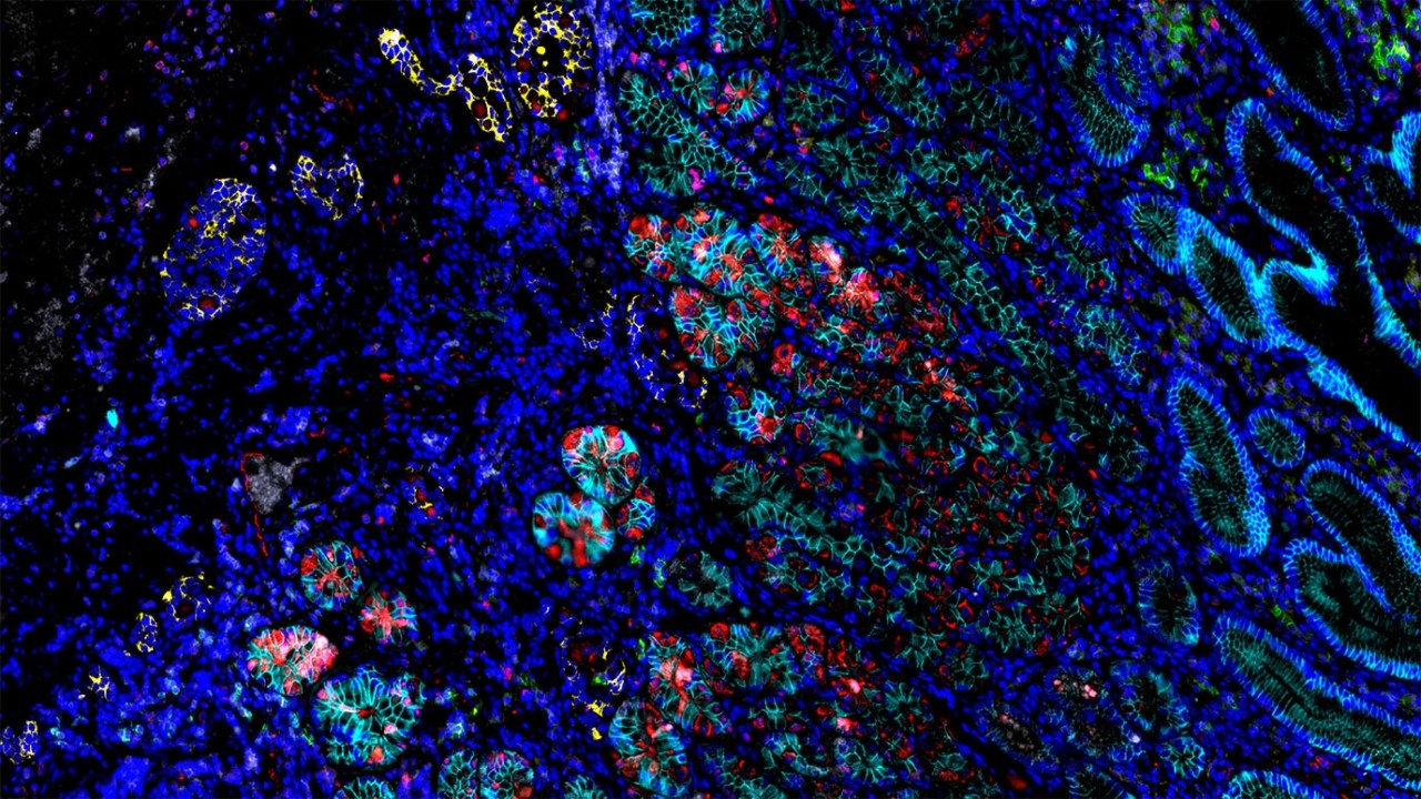 Gastric cancer mIHC