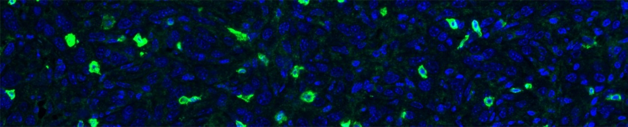 Infiltration of a pancreatic tumor by cytotoxic T cells (green) from an immunocompetent mouse that received the combination treatment with the glucocorticoid receptor antagonist (mifepristone) and dual immune checkpoint inhibitors (anti-PD1 + anti-CTLA-4).