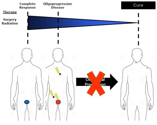 The spectrum of malignant disease is represented by blue ovals for primary prostate cancer and red circles for macroscopic metastases. Men in the oligometastatic disease state may benefit from both systemic therapy and local therapies.
