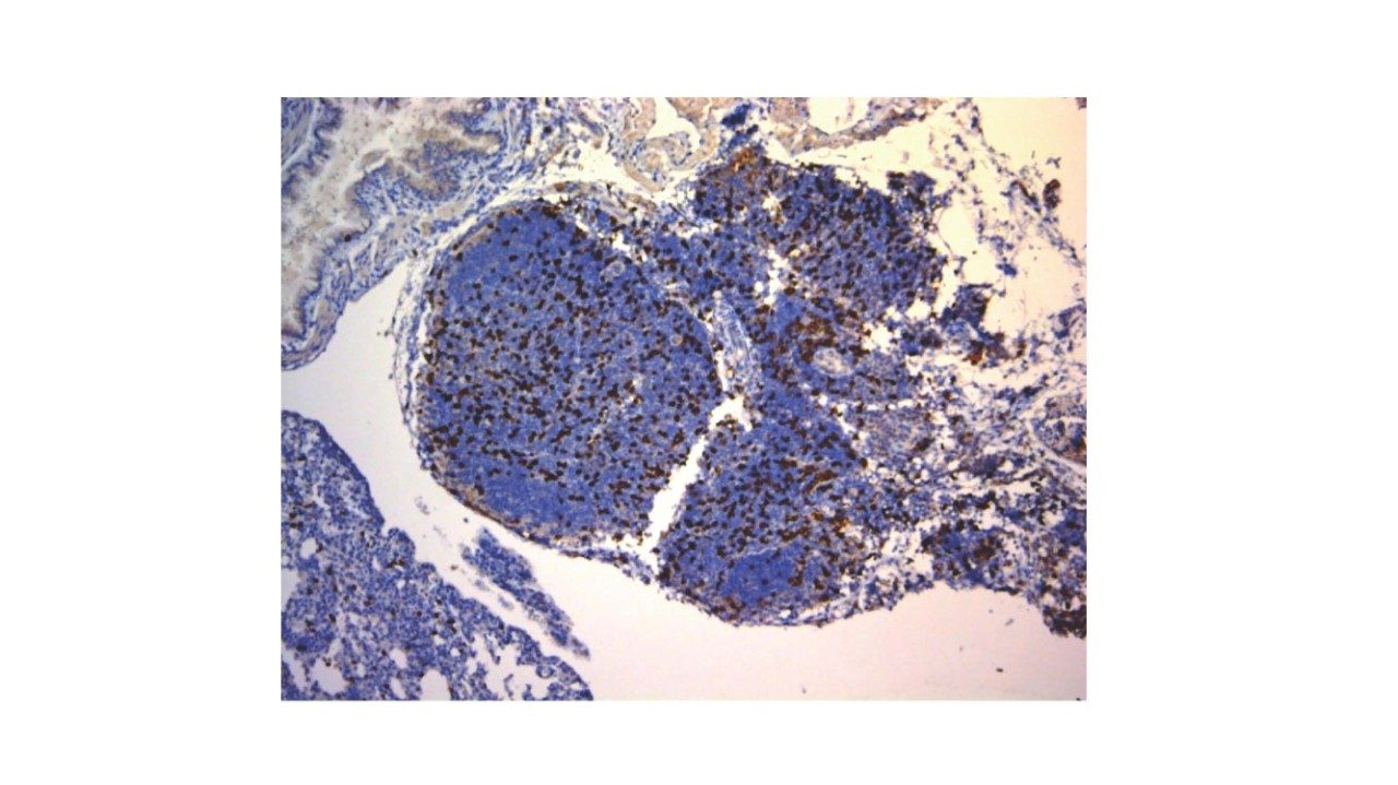  T-cell infiltration in osteosarcoma lung mets