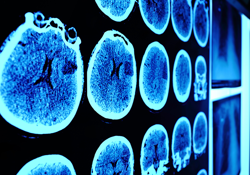 Combined Nivolumab and Ipilimumab in Melanoma Metastatic to the Brain