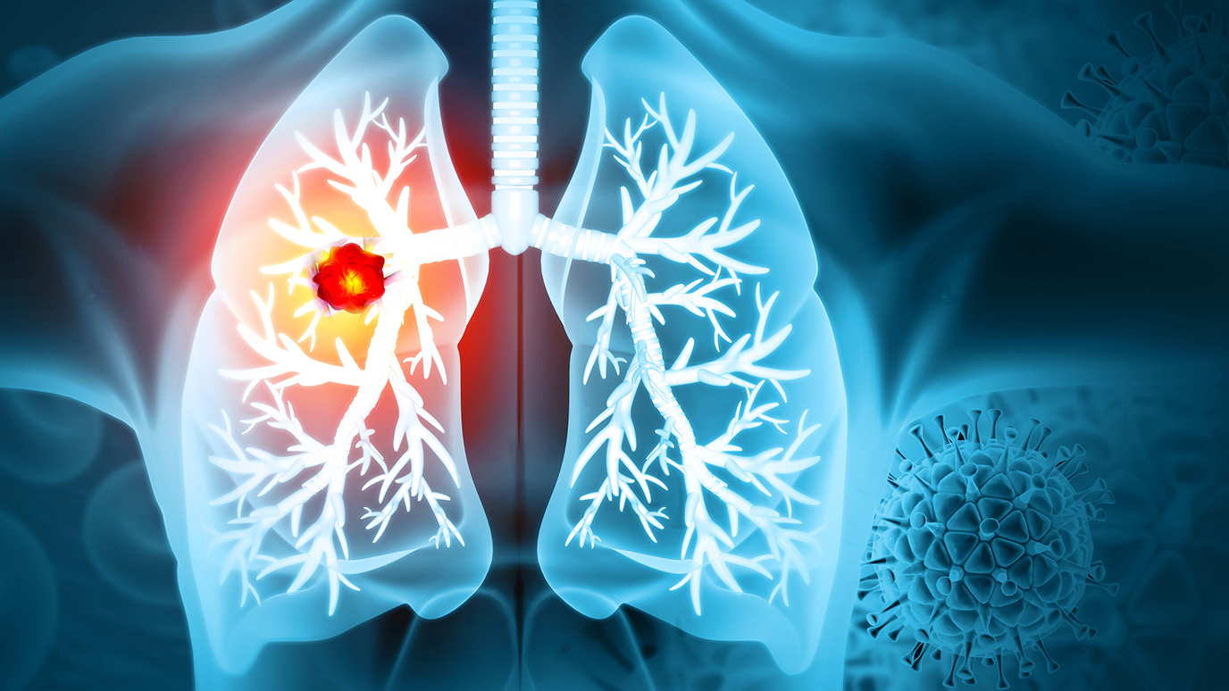 Daraxonrasib Shows Antitumor Activity in Previously Treated RAS-Mutant Non-Small-Cell Lung Cancer - News Directory 3