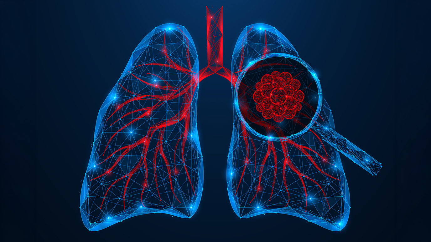 Researchers find biomarker of chemotherapy resistance in relapsed lung cancer (via mdanderson.org)
