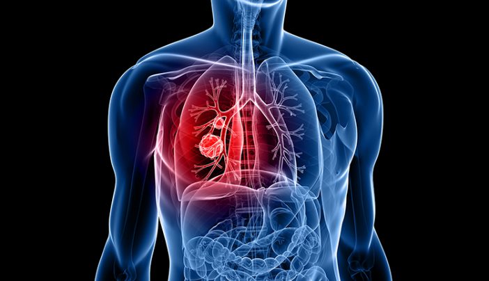 Lung cancer patients experience reduce pain and opioid use with