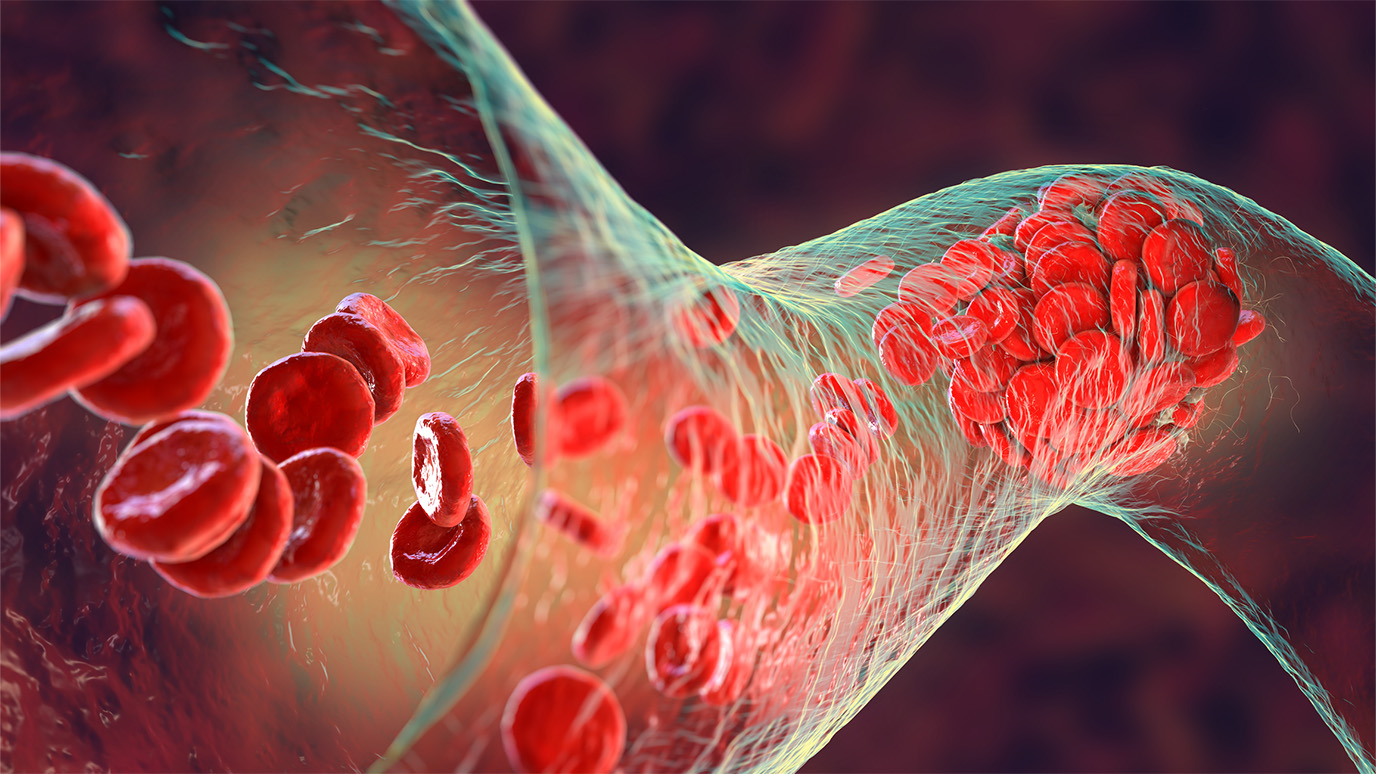 Deep vein thrombosis (DVT) as a side effect of cancer: 9 things to know |  UT MD Anderson
