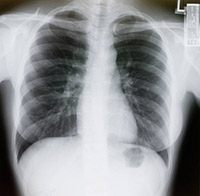 Lung cancer screening for smokers moves toward standard of care