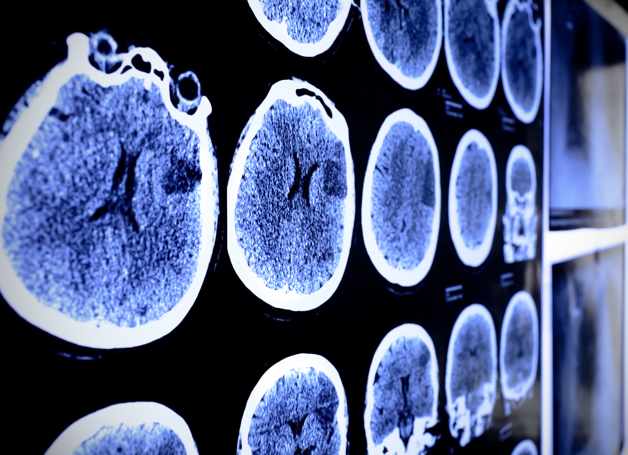 Two combination therapies shrink melanoma brain metastases in more than
