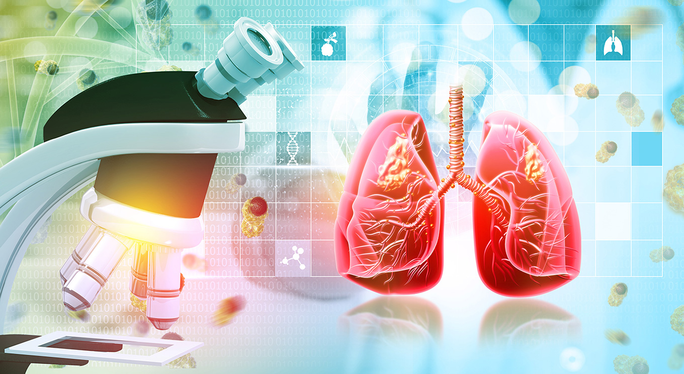 Lung Neoplasms 